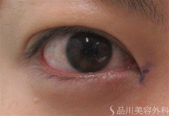 症例NO.18869のBEFORE写真
