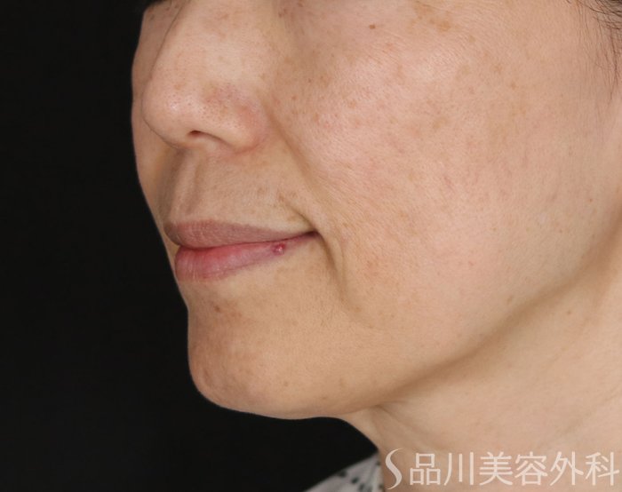 症例NO.74175のBEFORE写真