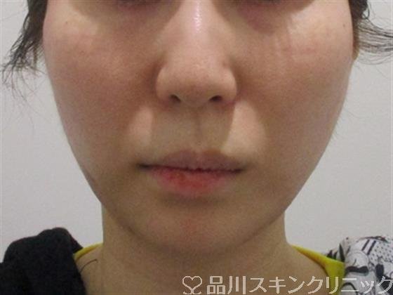 症例NO.37040のAFTER写真