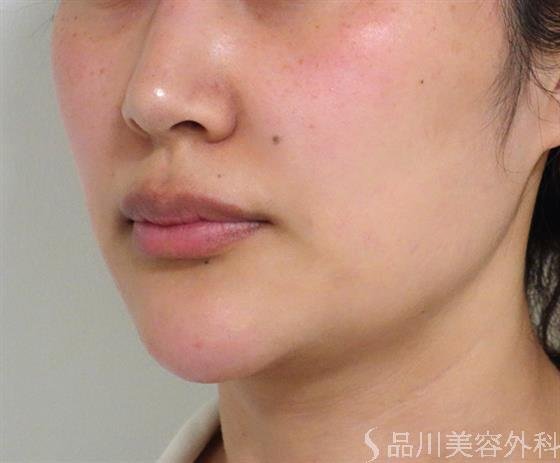 症例NO.38011のBEFORE写真