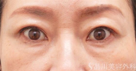 症例NO.55879のAFTER写真