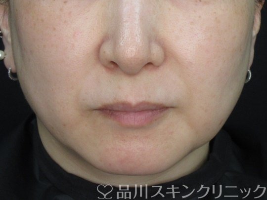 症例NO.74979のAFTER写真