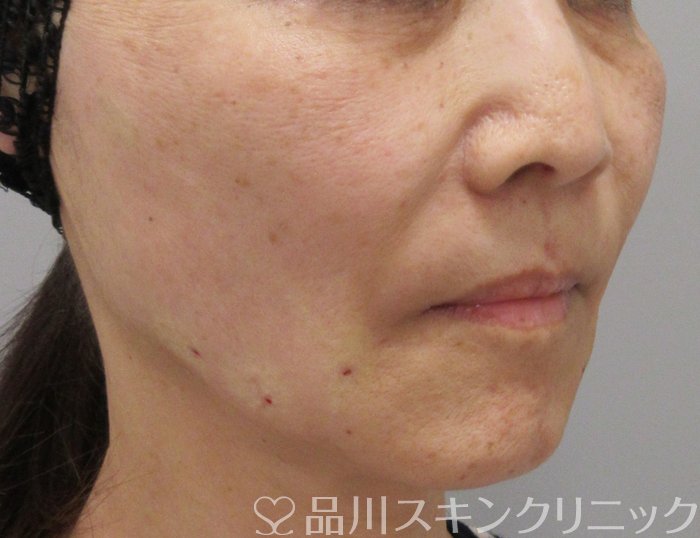 症例NO.72894のAFTER写真