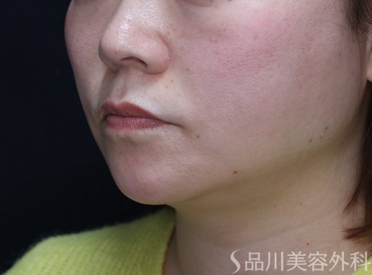 症例NO.72693のAFTER写真