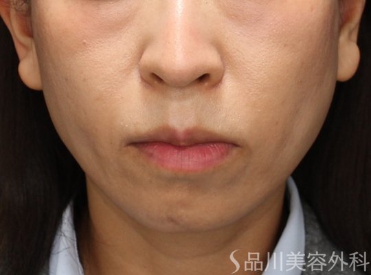 症例NO.74124のAFTER写真