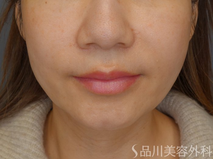 症例NO.69630のBEFORE写真