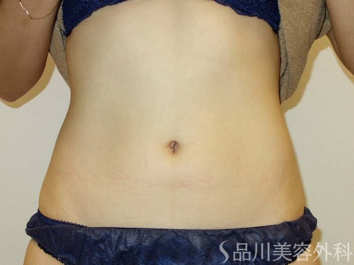症例NO.70879のAFTER写真