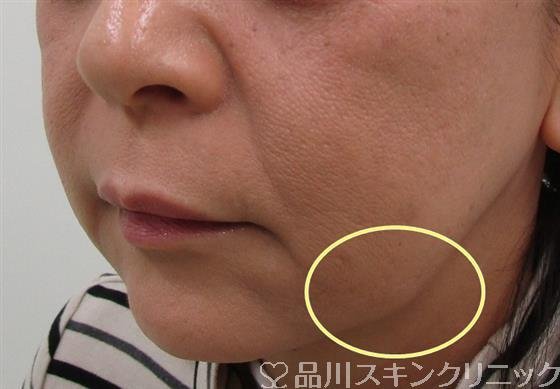 症例NO.34502のBEFORE写真