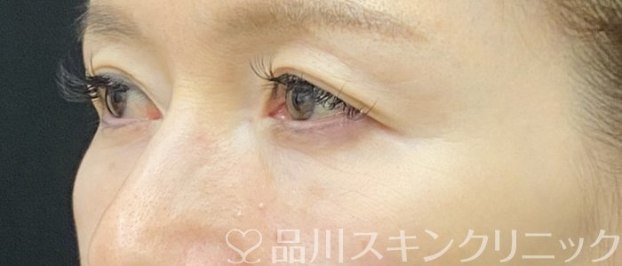 症例NO.75170のAFTER写真