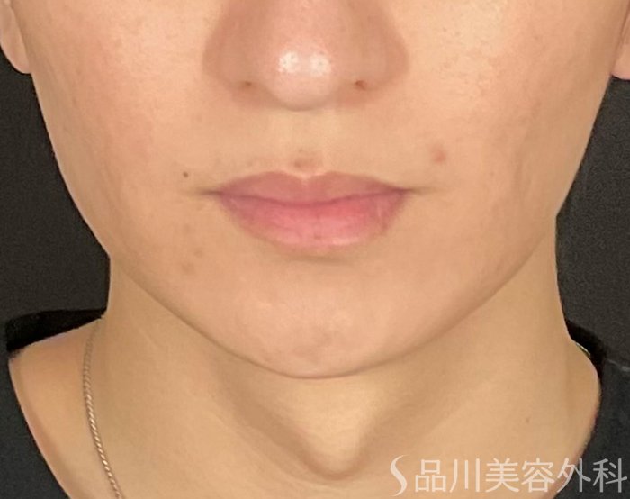 症例NO.75227のBEFORE写真