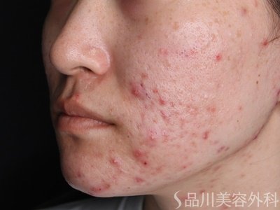 症例NO.74463のBEFORE写真