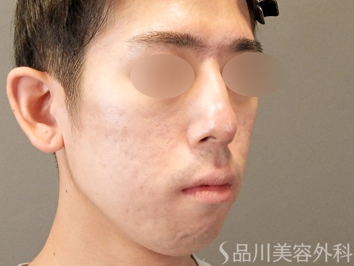 症例NO.67619のAFTER写真