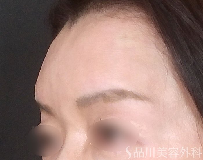 症例NO.67645のAFTER写真