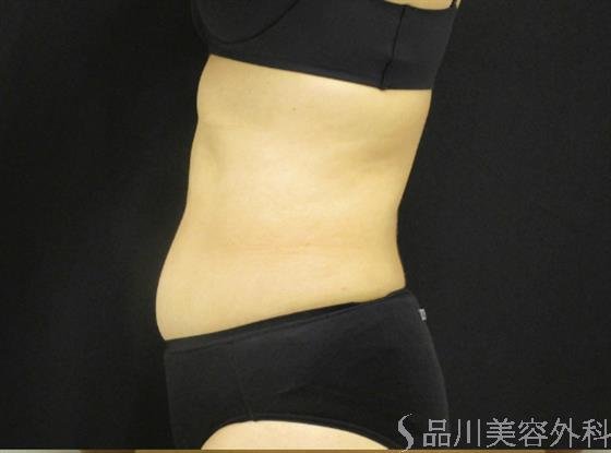 症例NO.49416のBEFORE写真