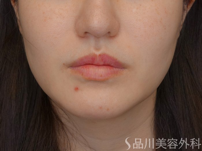 症例NO.71029のBEFORE写真