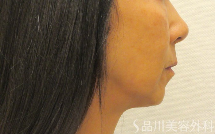 症例NO.71897のAFTER写真