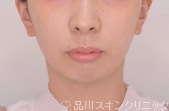 症例NO.69318のBEFORE写真