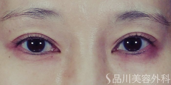 症例NO.70352のBEFORE写真