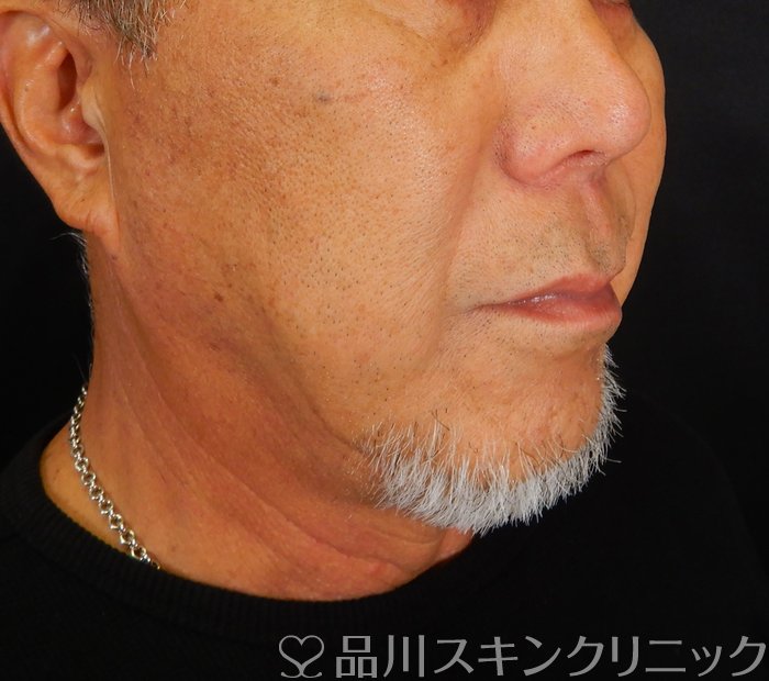 症例NO.66347のAFTER写真