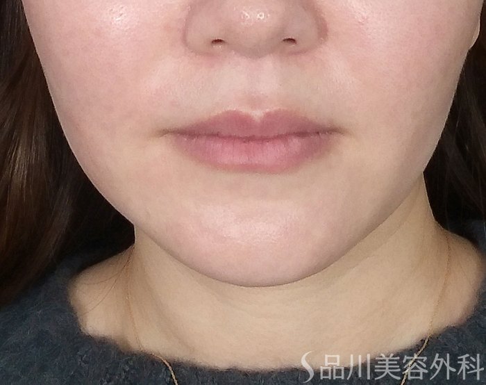 症例NO.73392のBEFORE写真