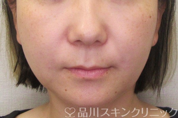 症例NO.70410のAFTER写真