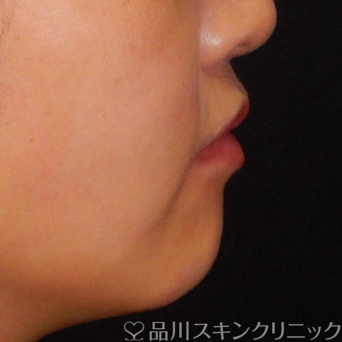 症例NO.64088のBEFORE写真