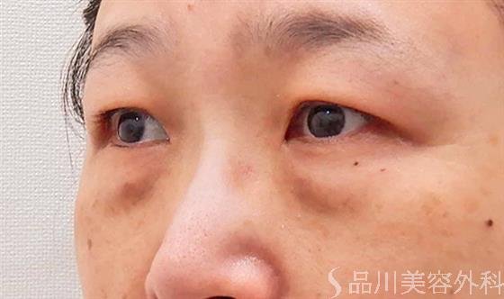 症例NO.61052のBEFORE写真