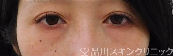 症例NO.42401のBEFORE写真