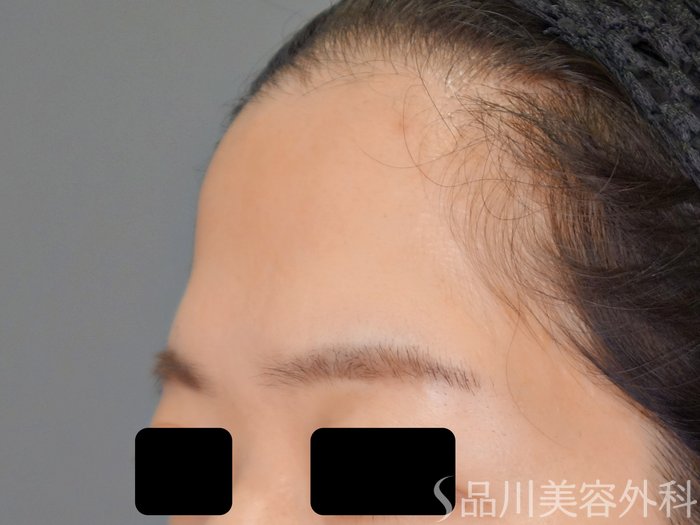 症例NO.70647のBEFORE写真