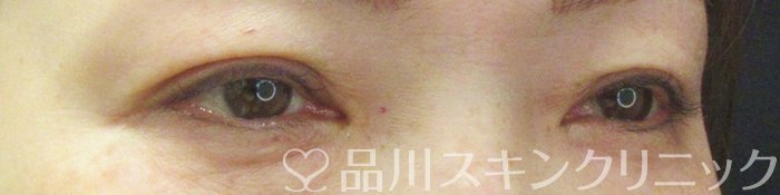 症例NO.70067のAFTER写真