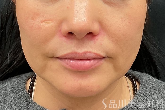 症例NO.73320のBEFORE写真