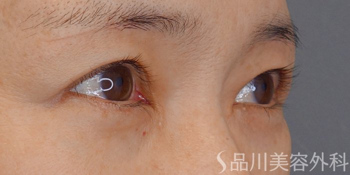 症例NO.72104のBEFORE写真