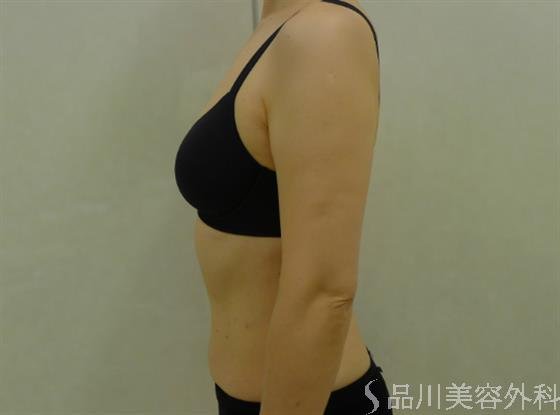 症例NO.34166のAFTER写真