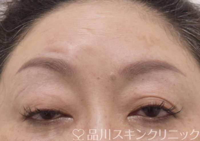 症例NO.75255のBEFORE写真