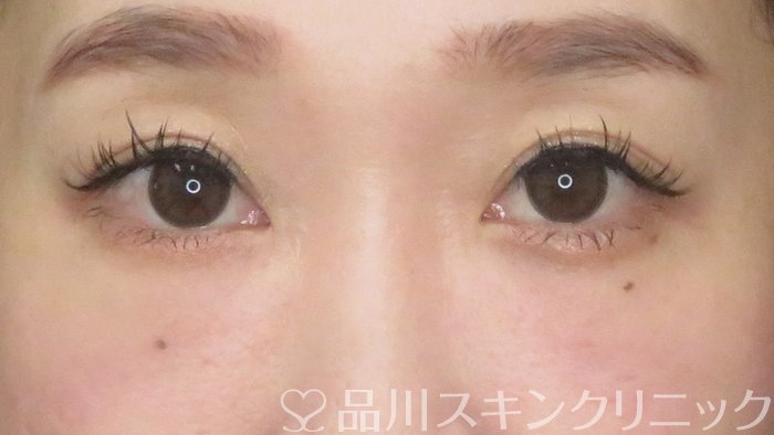 症例NO.67647のAFTER写真