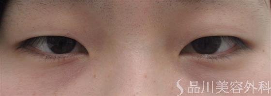 症例NO.20646のBEFORE写真
