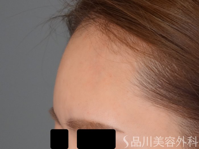 症例NO.68258のAFTER写真