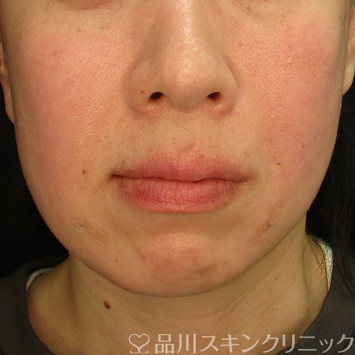 症例NO.73765のAFTER写真