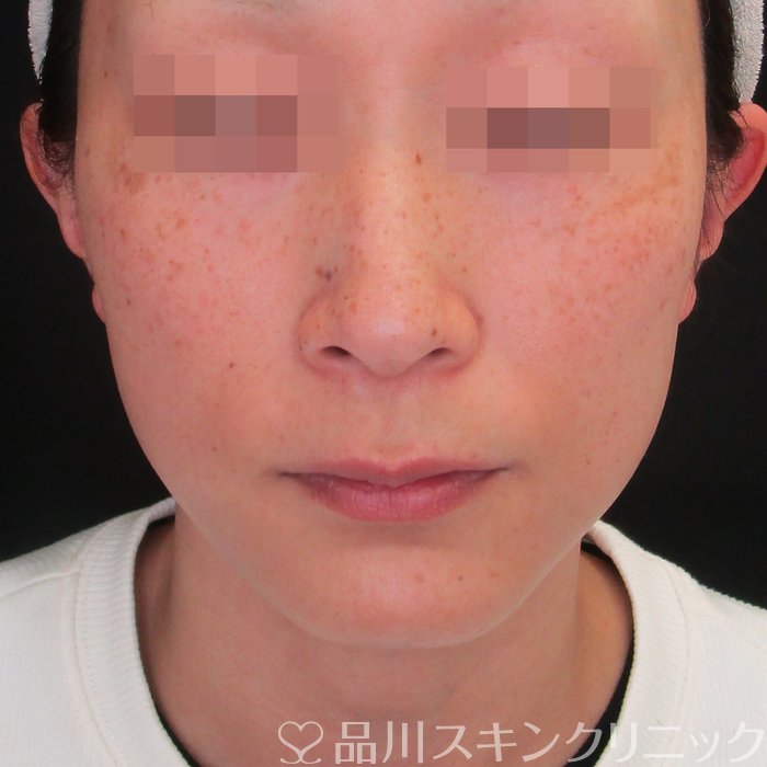 症例NO.75143のBEFORE写真