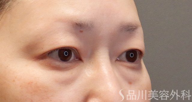 症例NO.74956のBEFORE写真