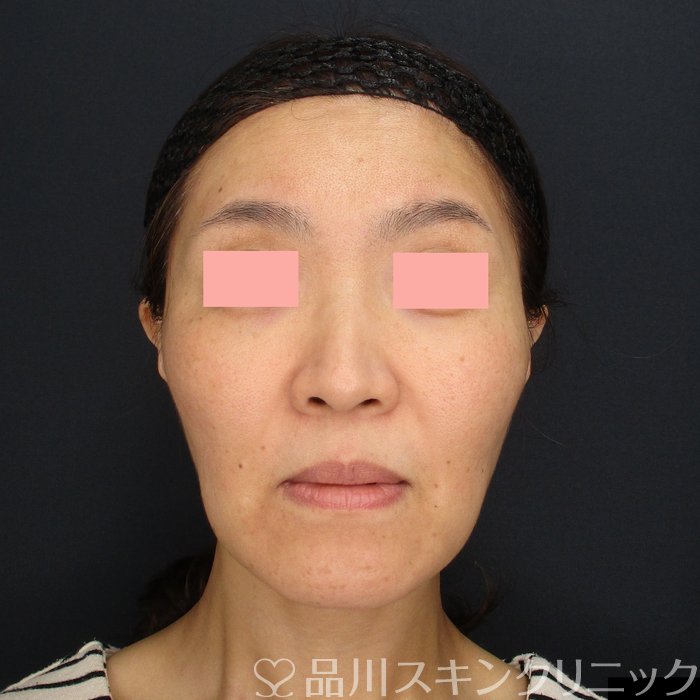 症例NO.72450のBEFORE写真