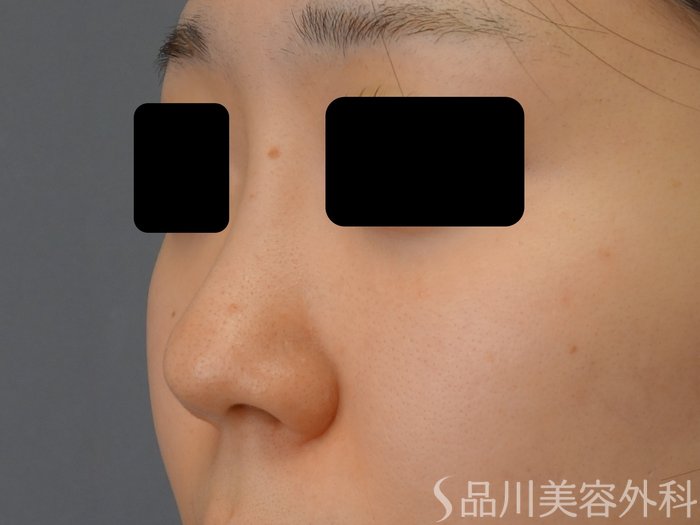 症例NO.74676のBEFORE写真