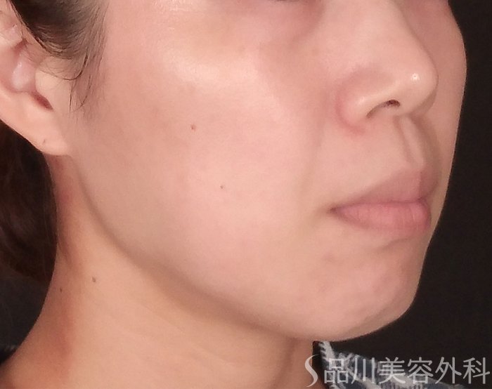 症例NO.71280のBEFORE写真