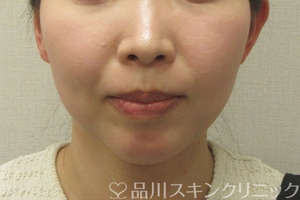 症例NO.74576のAFTER写真