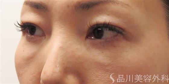 症例NO.45906のAFTER写真