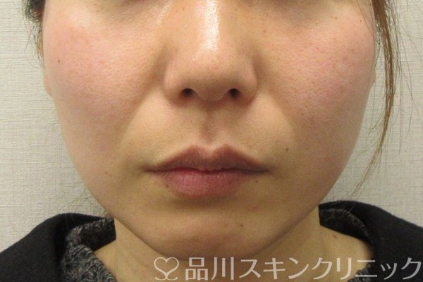症例NO.69277のBEFORE写真