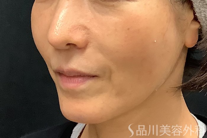 症例NO.71248のAFTER写真