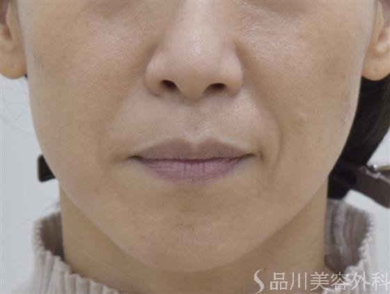 症例NO.51124のBEFORE写真