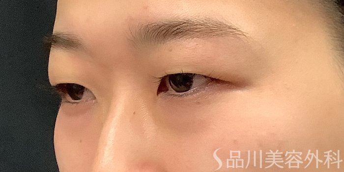 症例NO.71231のBEFORE写真