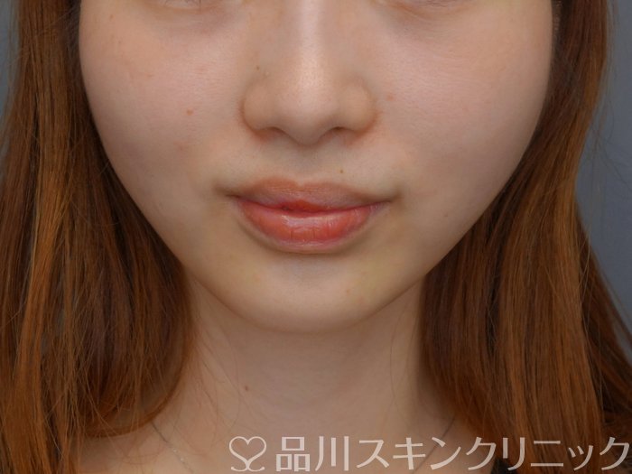 症例NO.74192のAFTER写真